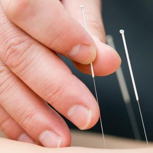 Needling skin, a acupuncture service at Territory Medical Centre, Medical Centre Darwin
